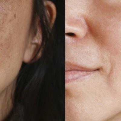 011019-Chemical-Peels-SDBotox-768x448